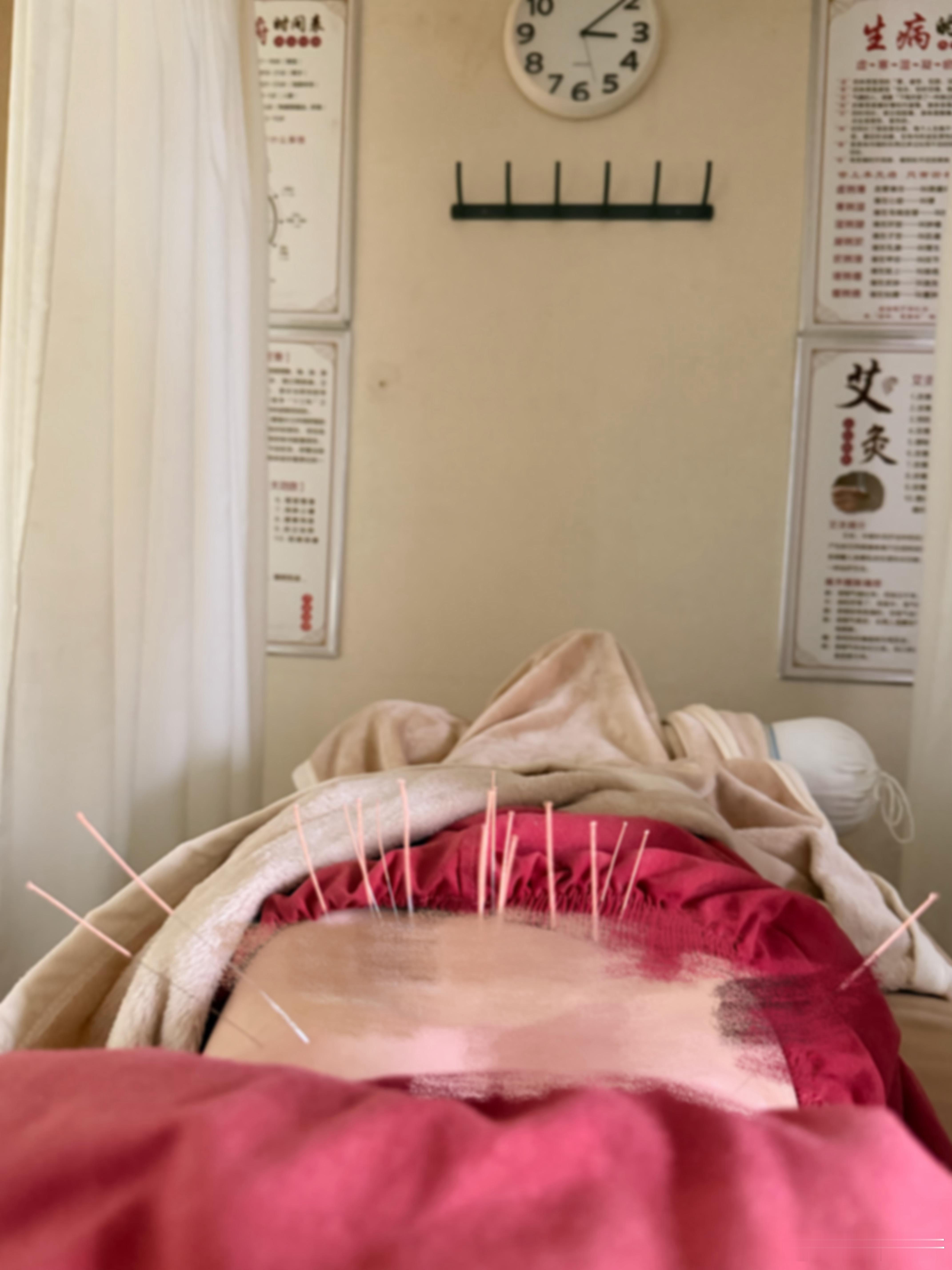 要死了太痛了 针灸 