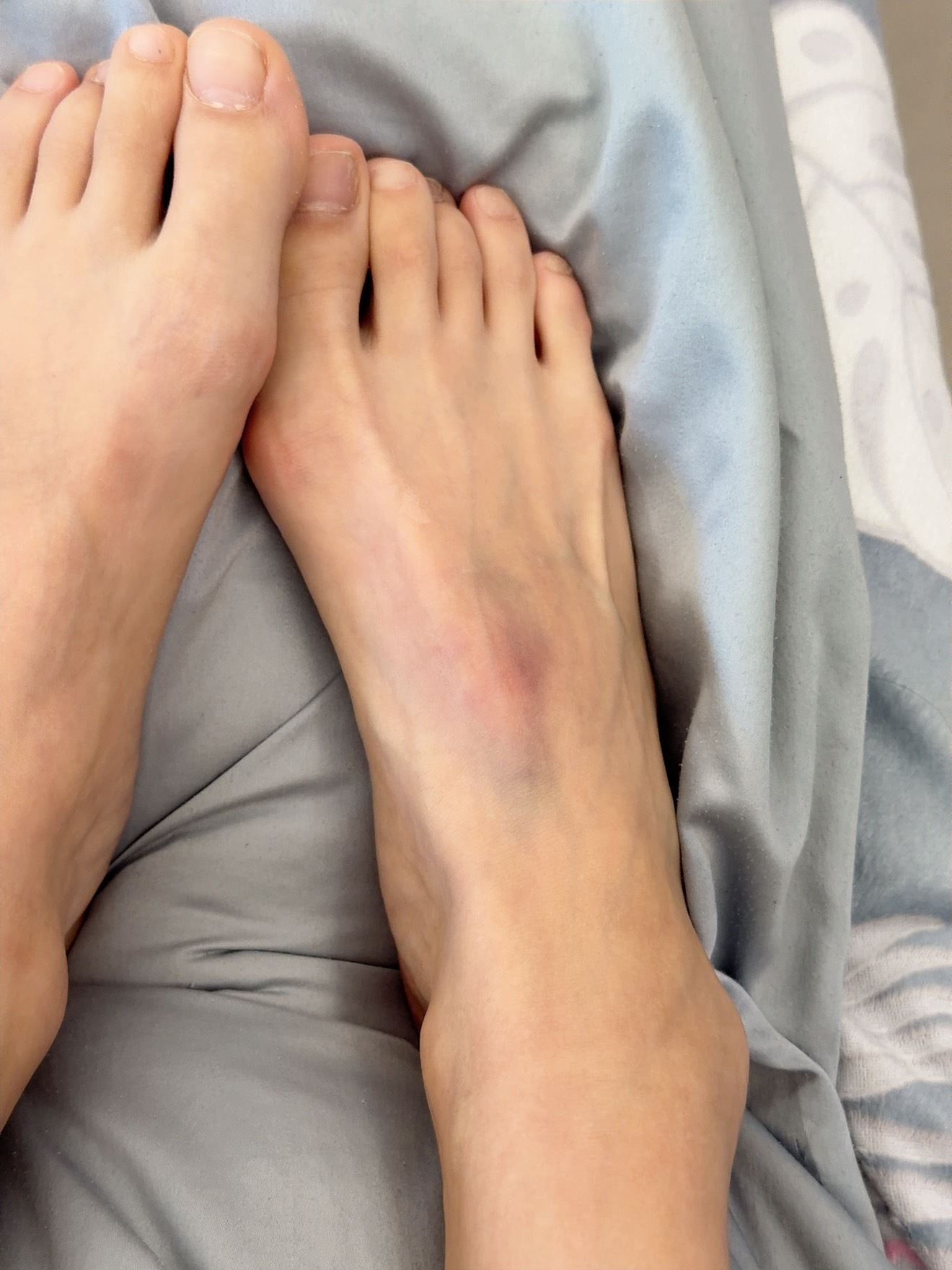 这就是洗澡玩手机的代价手机掉下来把jio砸雀青 