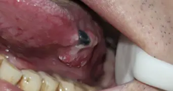 不是上火，是癌！男子被切掉半条舌头！知名女歌手也因此告别歌坛，这个信号注意