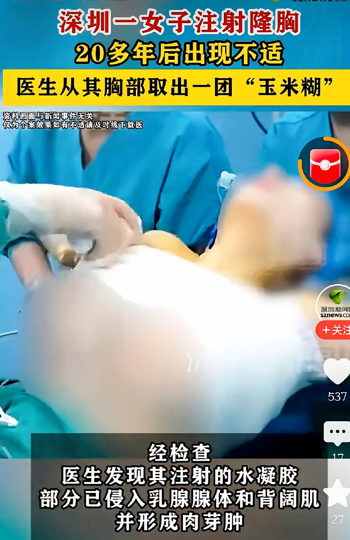 深圳这位女士二十多年前跟风做注射隆胸，当初宣传说得轻巧不用开刀，如今身体发出不适