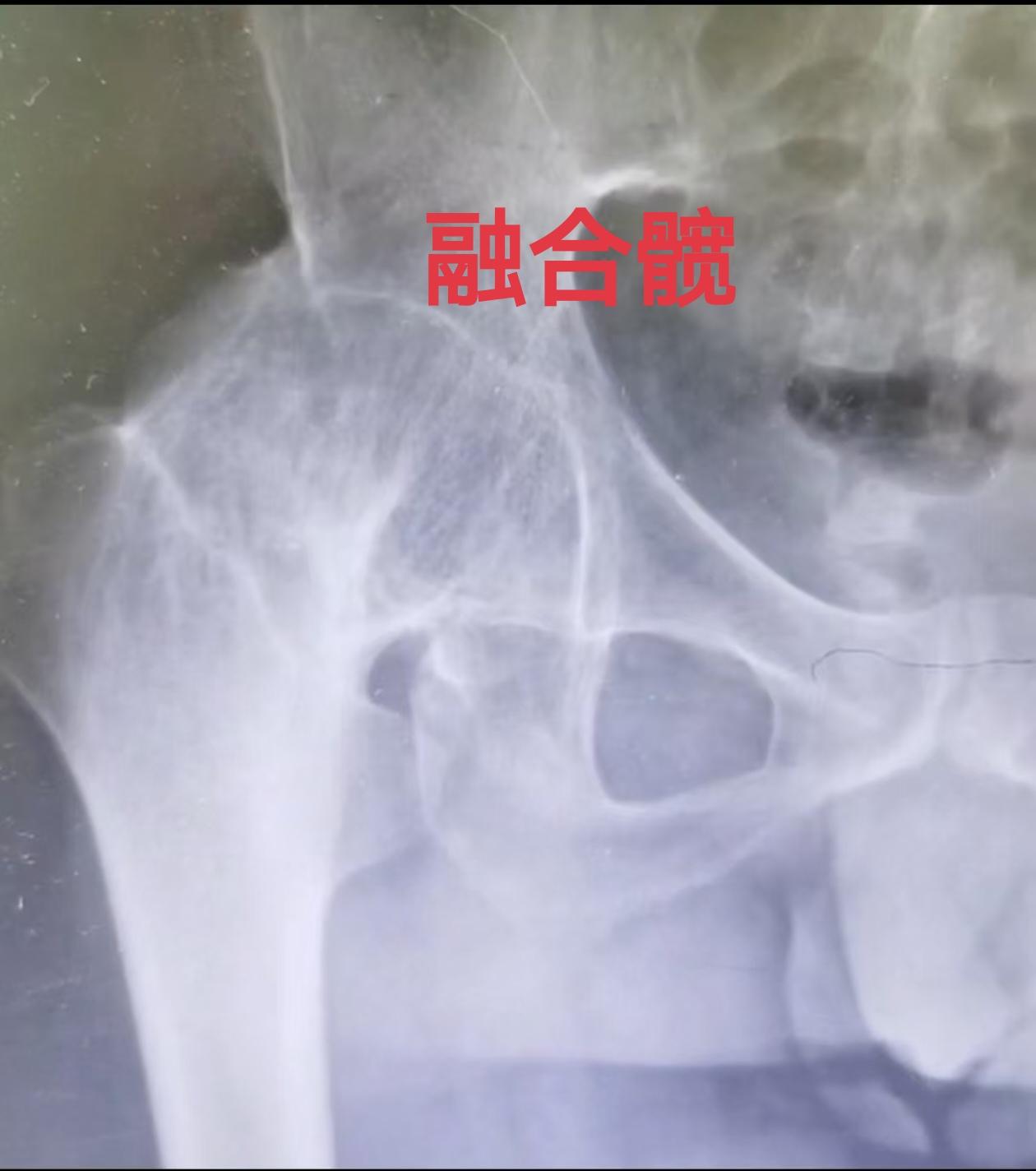 髋关节置换。融合髋，就是髋关节骨性融合，没有一点点活动度，是初次THA...