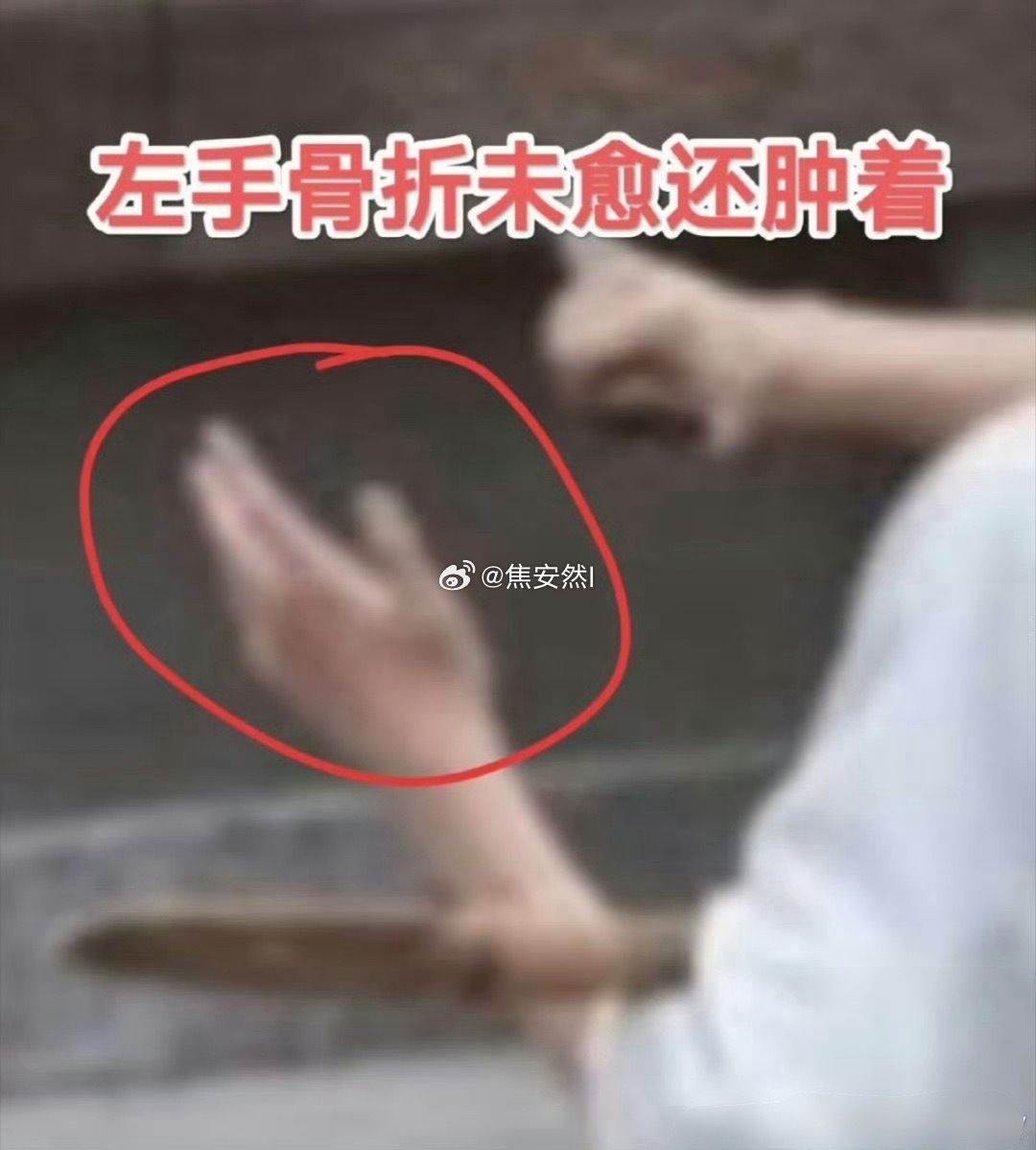 虽然拍戏受伤在所难免，可是杨洋左手受伤还没好又把他右手给整受伤了这就有些离谱了…