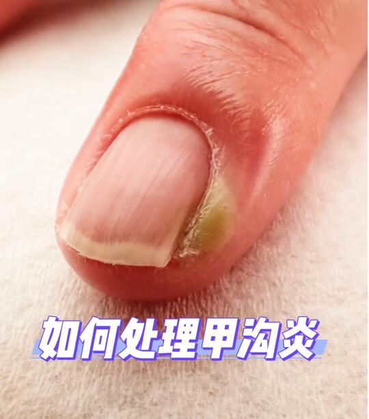如何处理甲沟炎？