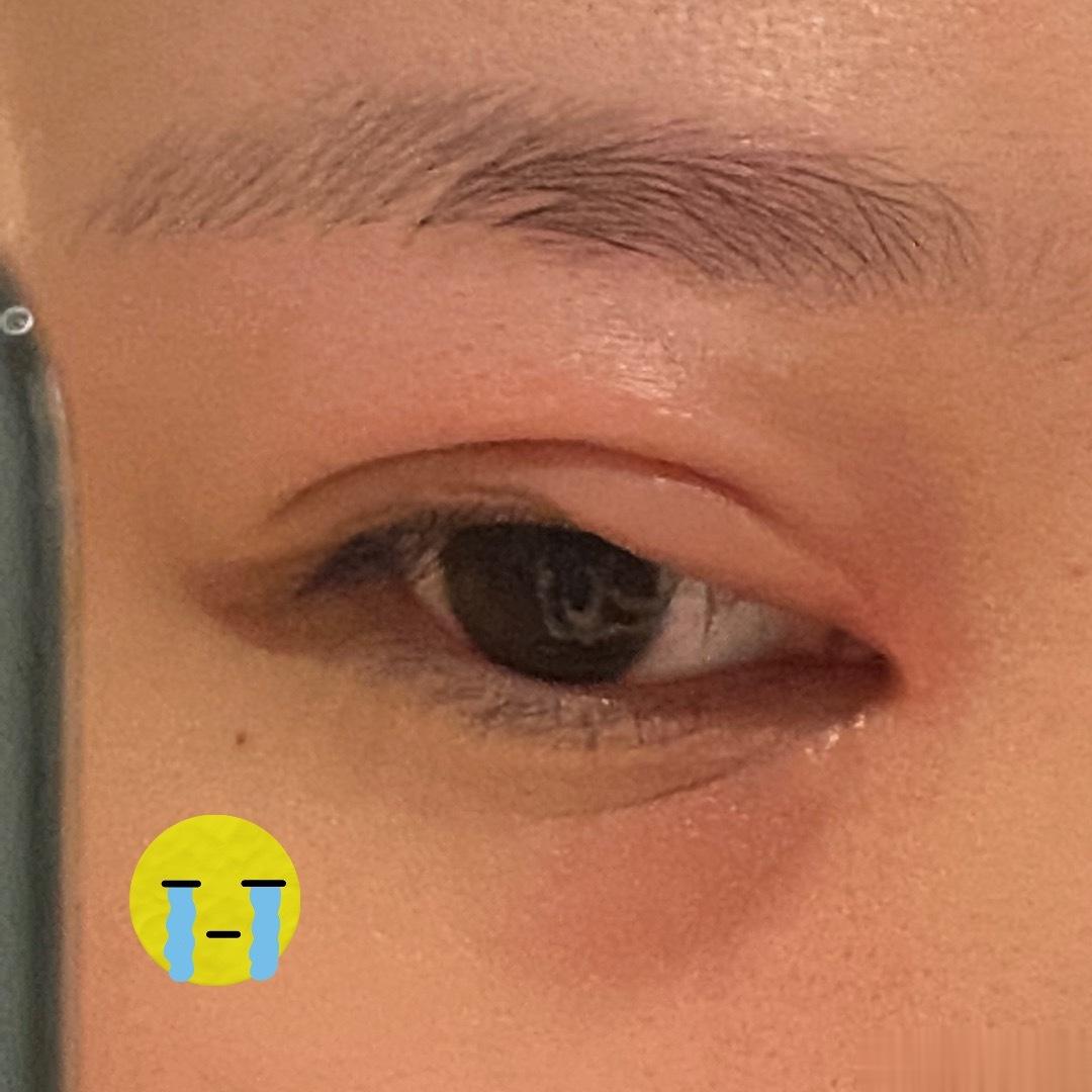 真是好笑……谁家好蚊子能叮人眼皮上 ​​​