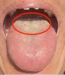 三焦一堵，全身皆病！这种舌头，别再误当肝郁肾虚补，越补火越旺！

其实很多时候，