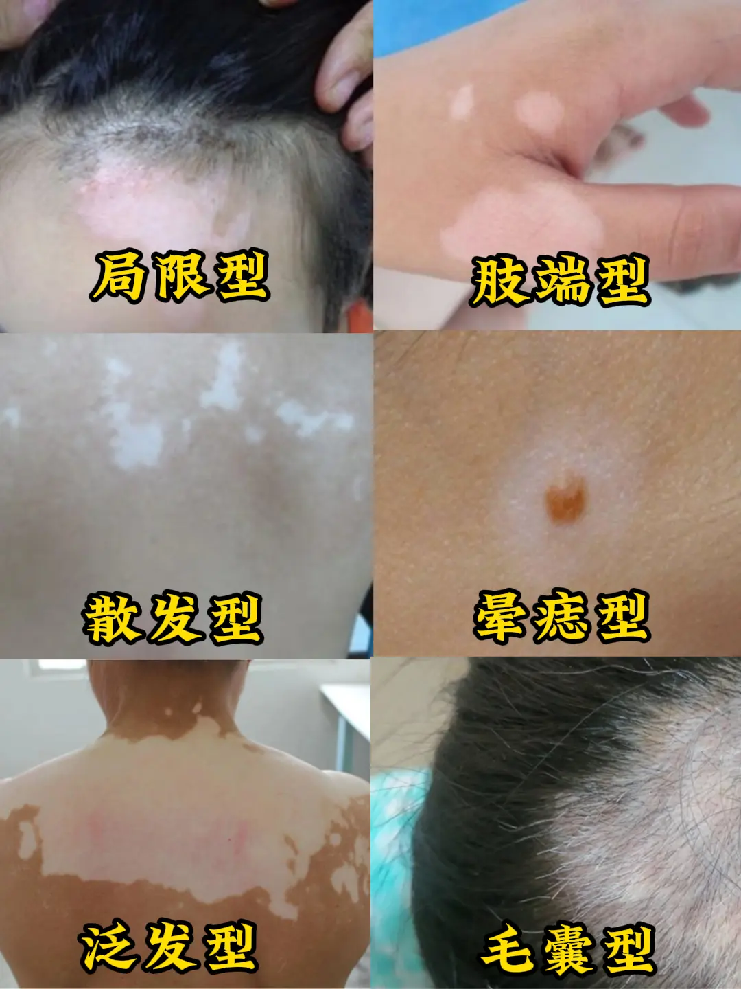 ①局限型白癜风是指白斑局限于一处，可一片或数片。 ②肢端型白癜风指白斑...