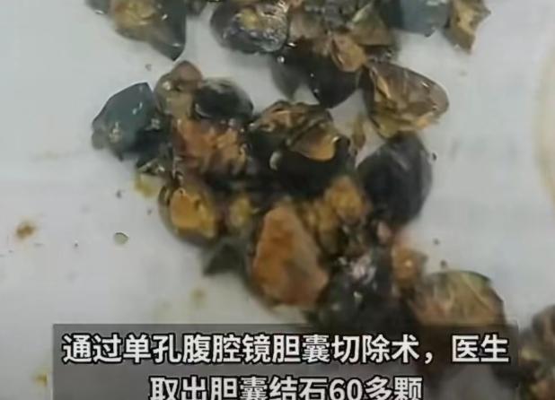 南京女子腹痛手术取出60多颗结石，医生只说一句警示。

南京35岁的王女士被送进