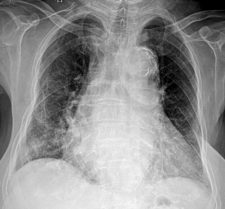 咳嗽胸闷就诊 男81岁
