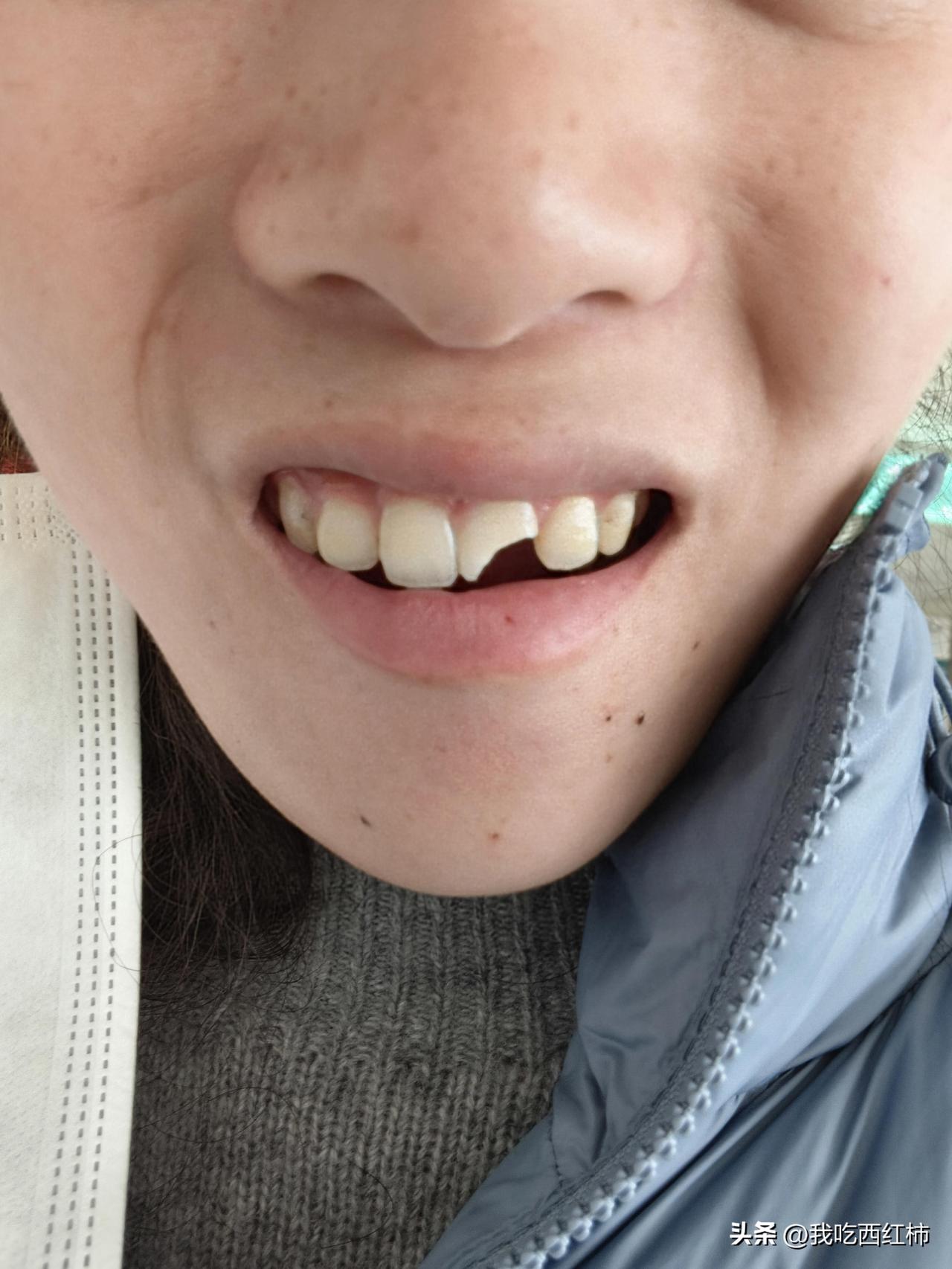 有没有牙医朋友我快痛死了
正月十四我被雪滑倒把门牙摔断了当时立即去了我们县城的医