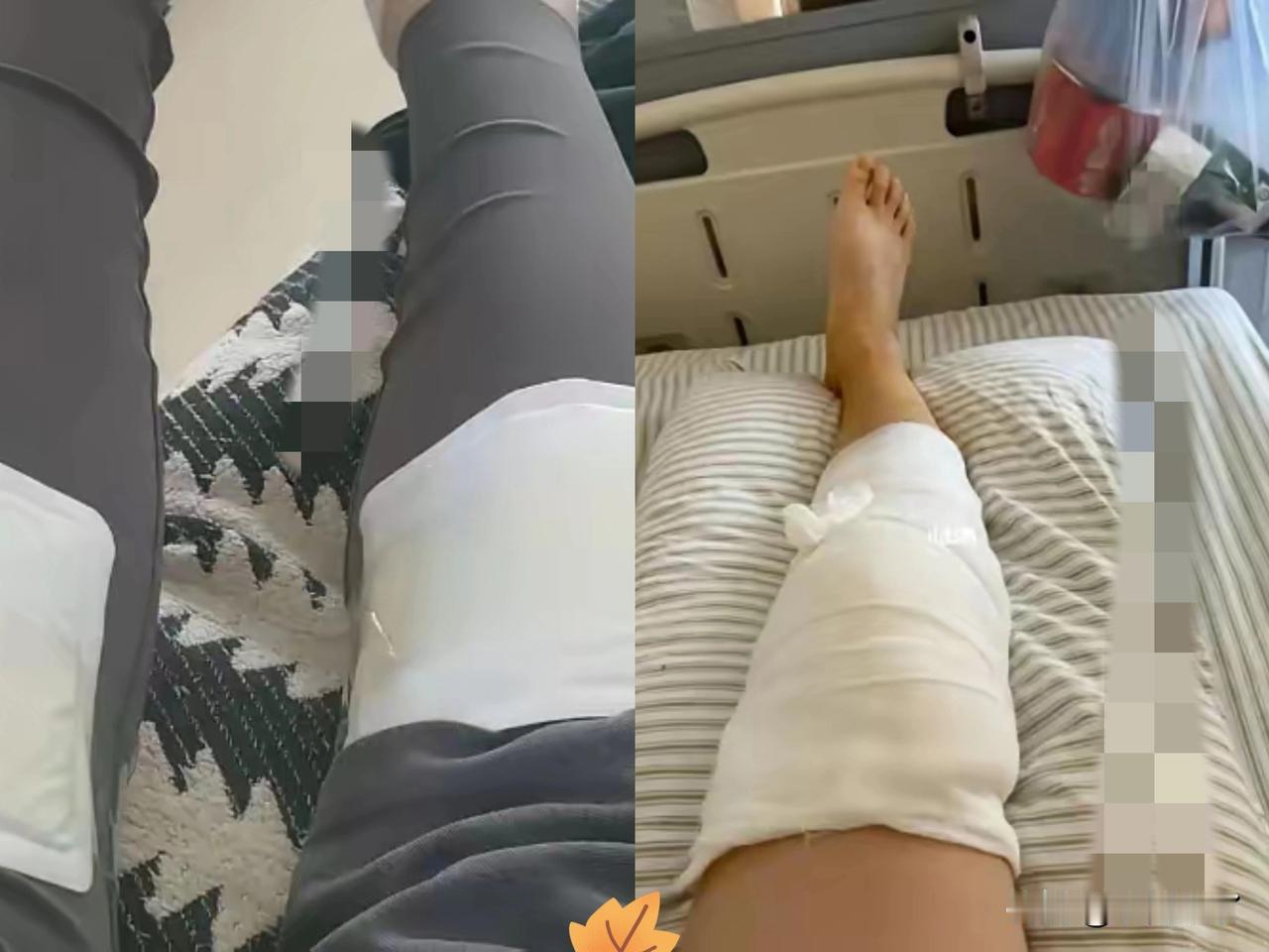 近日，湖南长沙，一男子为了缓解膝盖疼，将“暖宝宝”直接贴在膝盖上，连续3晚都是这