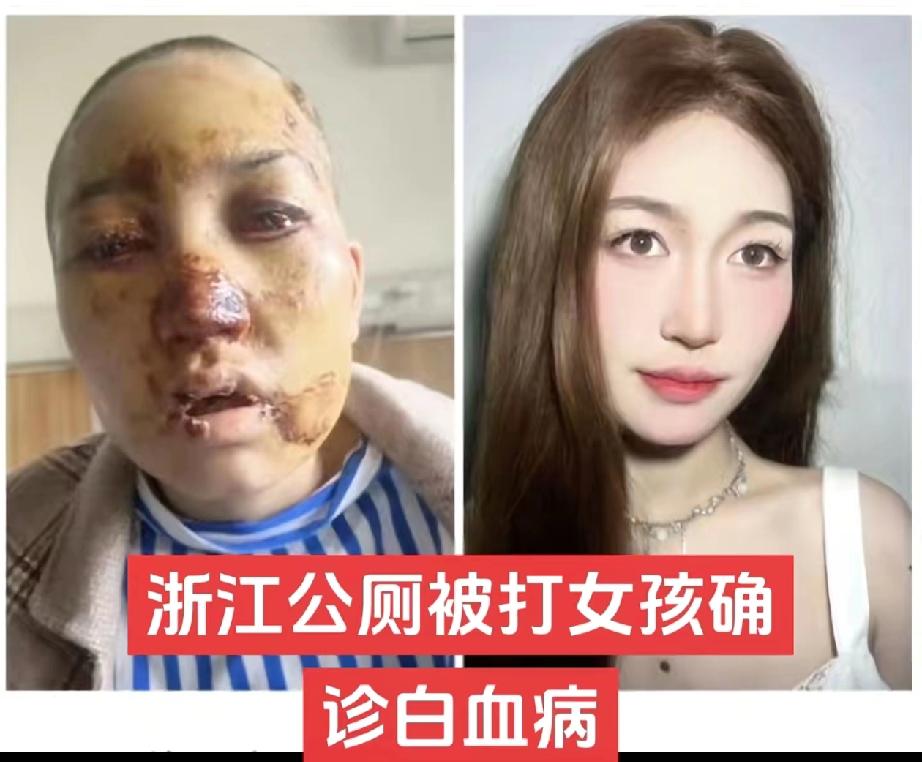 女孩在公厕被暴打案已过去三年了，仍没等到对方家人的道歉，而旧伤未好，如今却又患上