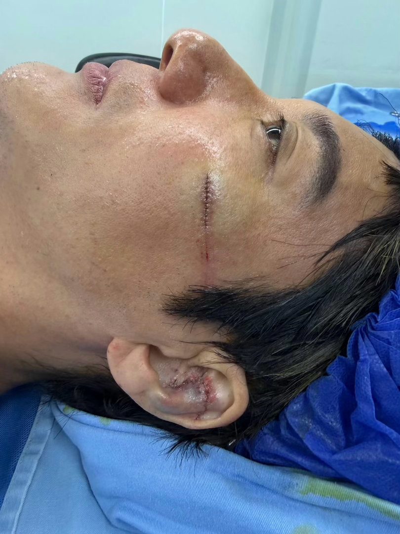 王力宏缝了39针成都演唱会意外绊倒，侧脸磕在金属台阶，耳软骨碎裂缝27针、面部伤