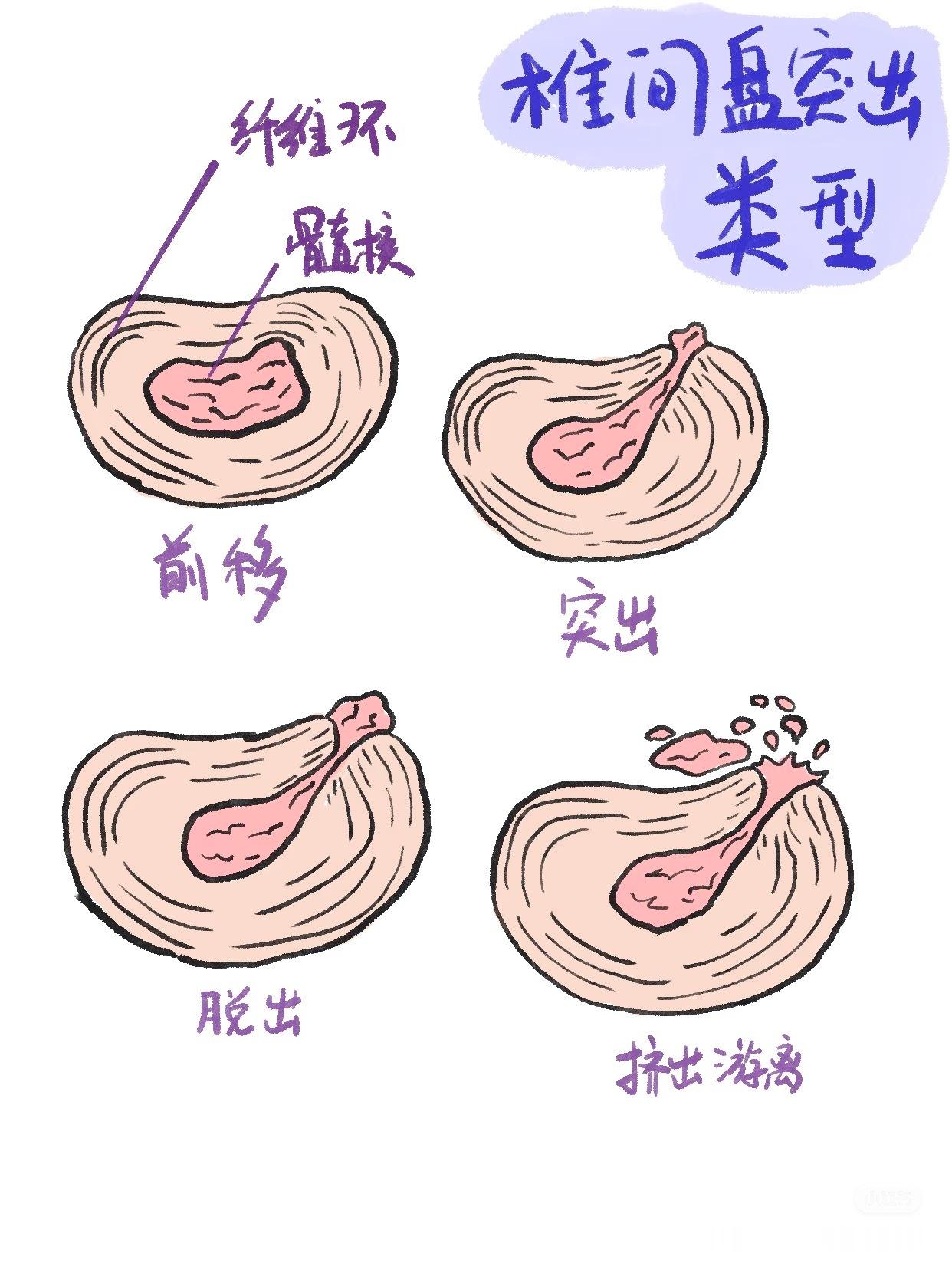 腰椎间盘突出 来看不同的腰突类型——👉膨出型：椎间盘整体向外膨胀，但未破裂。?