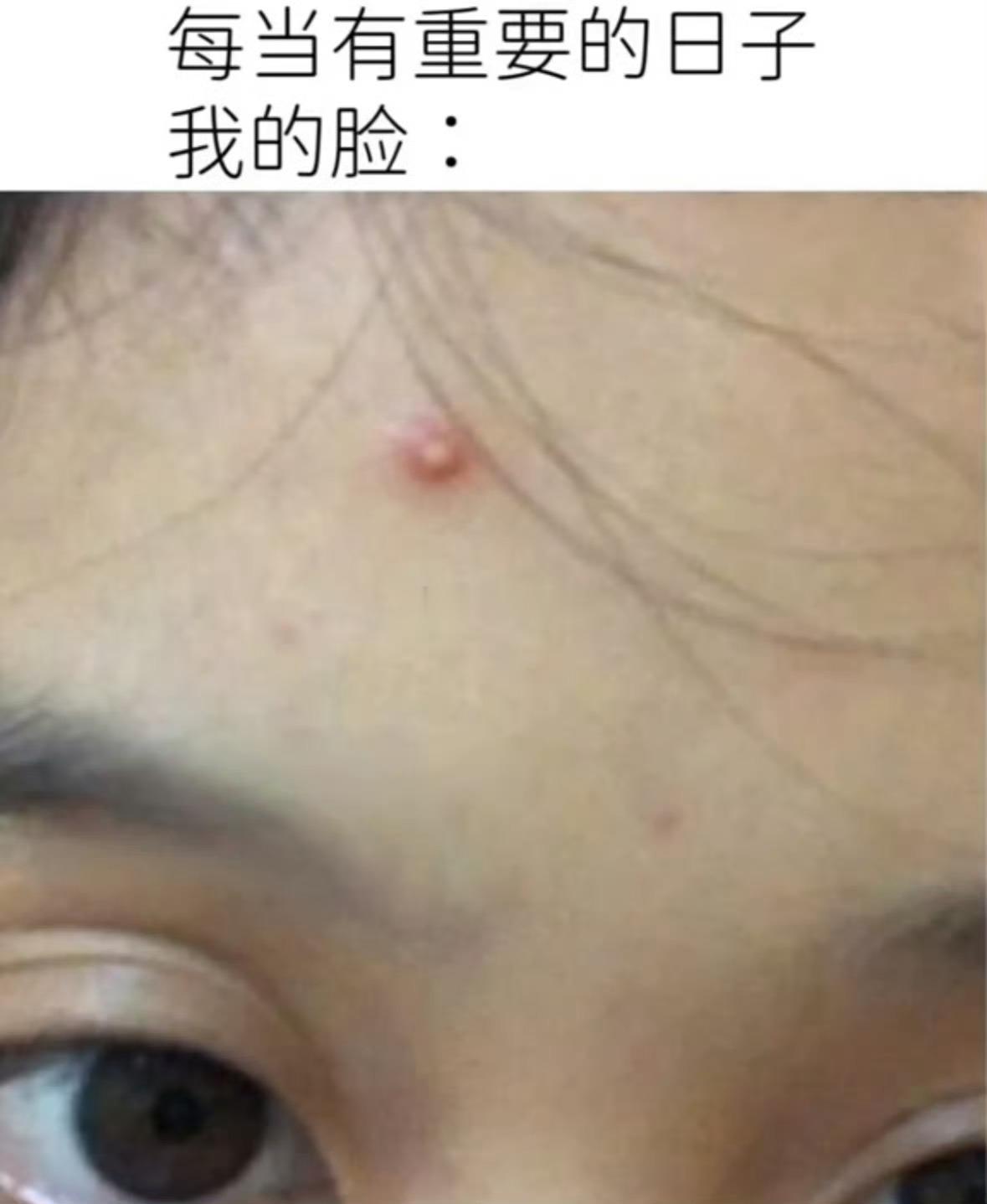 当我要出门的时候，痘比我还兴奋 