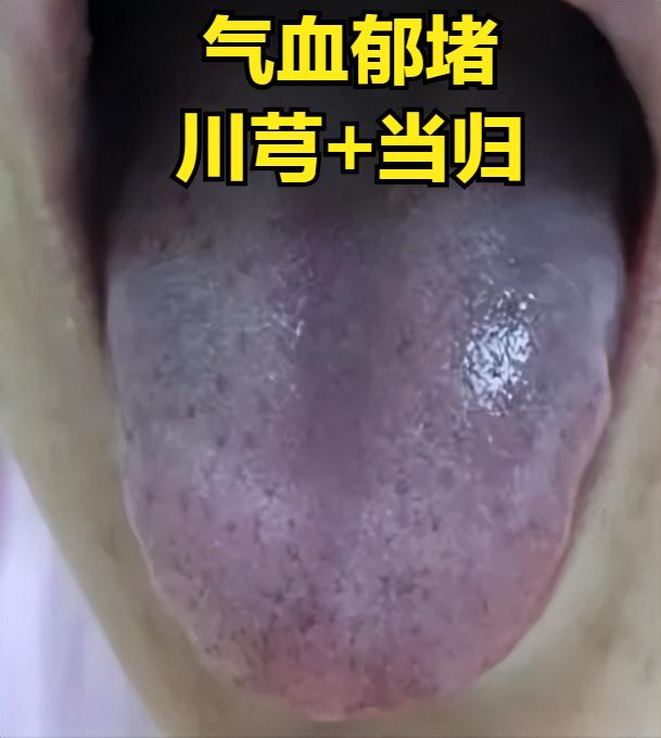 川芎+当归=气血瘀堵通了，黄连+肉桂=上热下寒没了，黄柏+苍术=下焦湿热没了
 