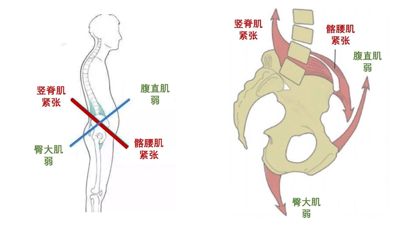 #儿童健康守护计划##儿童常见病必备手册# 宝宝挺胸凸肚？警惕“下交叉综合症”下