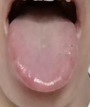 肝肾阴亏夹杂湿热，下焦气机阻滞宗筋失濡







不少身体过度耗损的朋友，即