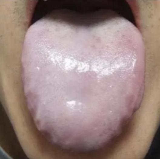 舌头白又滑，以为是阳虚寒湿，一个劲得温阳，那你真的在是白费力气

患者平时手脚冰