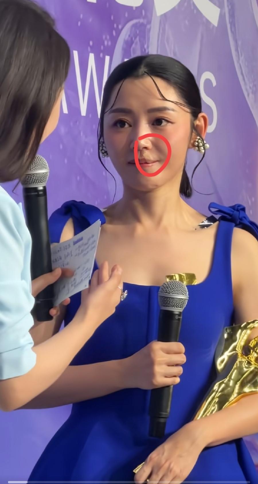 卫诗雅百合奖影后，带伤领奖，实则名归！
左上嘴唇贴了一个好像创可贴，应该是修护胶