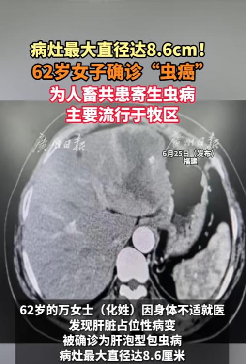 “给所有养宠家庭敲醒警钟！”福建一名62岁的万女士，就因为常年和宠物零距离相处，