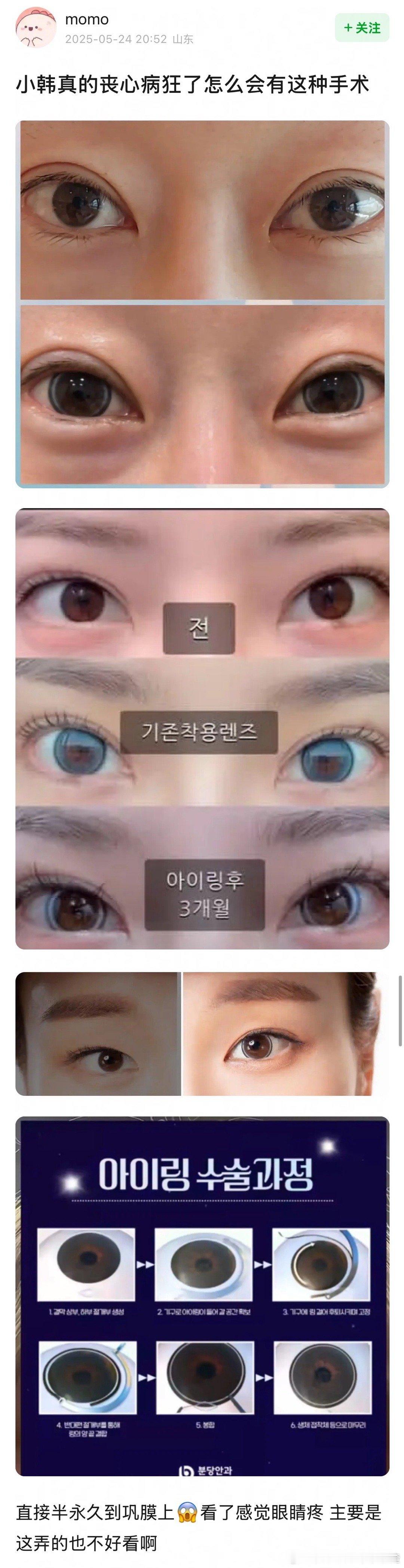 纹美瞳吗？ ​​​