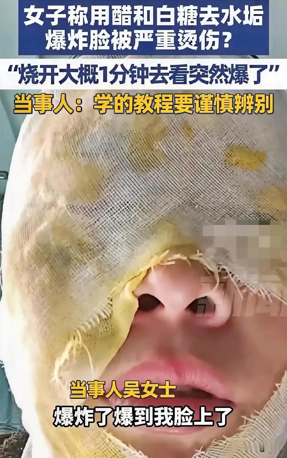 女子清洗水垢被炸伤！
切记：糖升温！醋生气！
河北一女子用糖和白醋去水垢，水开后