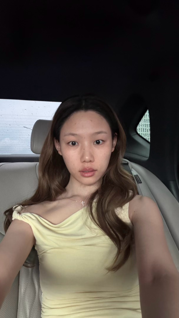 好圆的发际线要不要二植啊算了还是先不了 