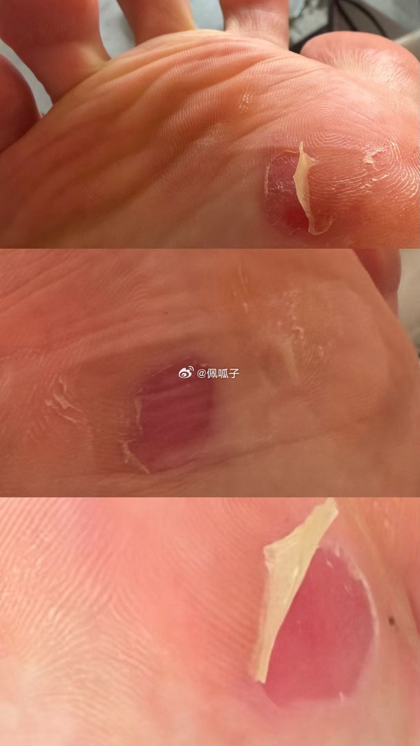 我已经精神错乱了 今天吃了两倍剂量的药物治愈我的情绪 整个人每天持续性爆哭 我不