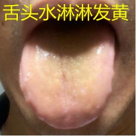 舌头水淋淋发黄，宗筋难起，房市力不从心，这种情况吃再多补肾的药都没多大用！
 
