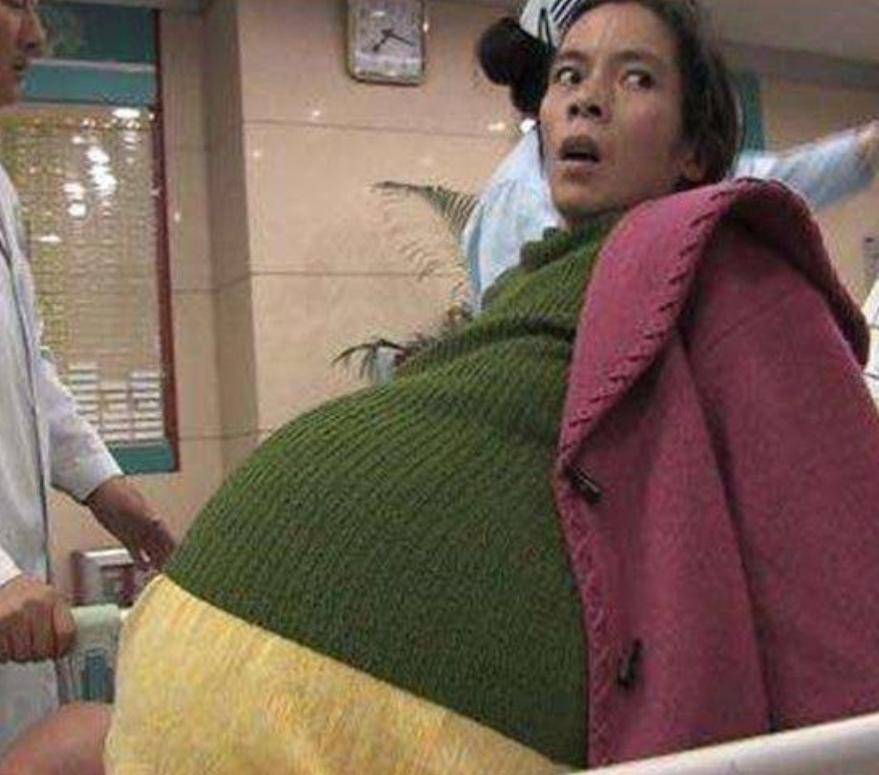 2007年，怀胎12个月的女人，在丈夫的陪同下，挺着巨肚，来到了广州医院检查，没