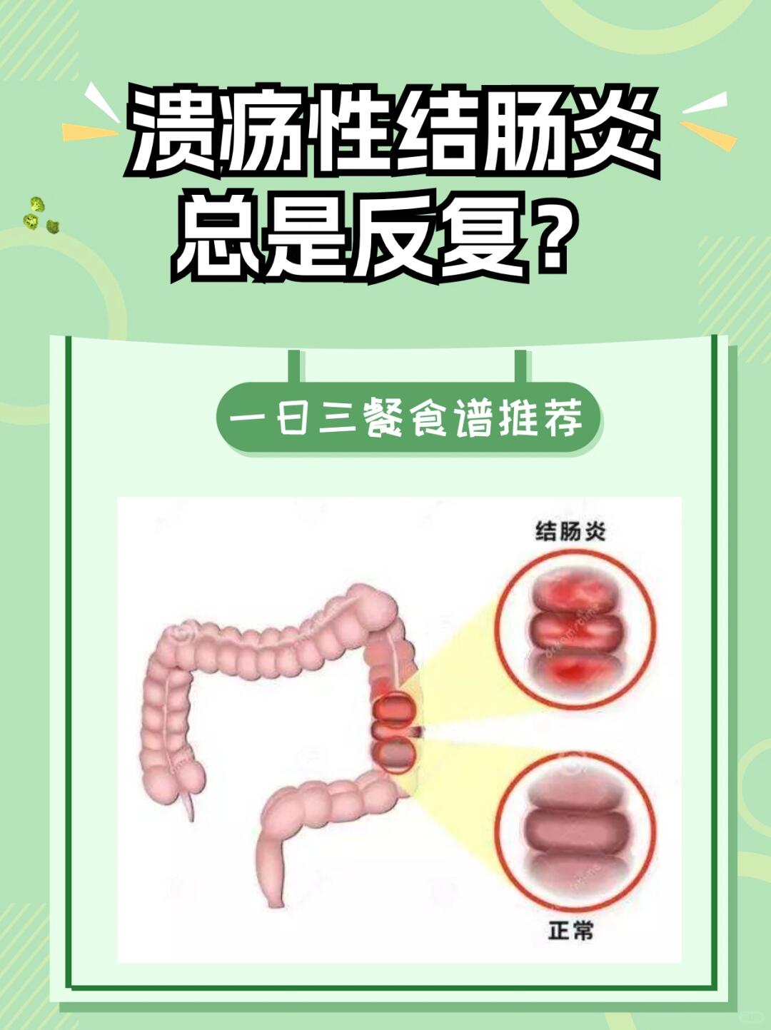 溃疡性结肠炎饮食 溃疡性结肠炎 中医顾思臻 青玉散