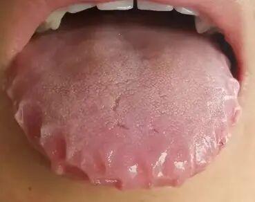 湿气背后：揭秘齿痕舌延伸至舌尖的真相
对于如此严重的齿痕舌，单纯祛湿已不足以应对