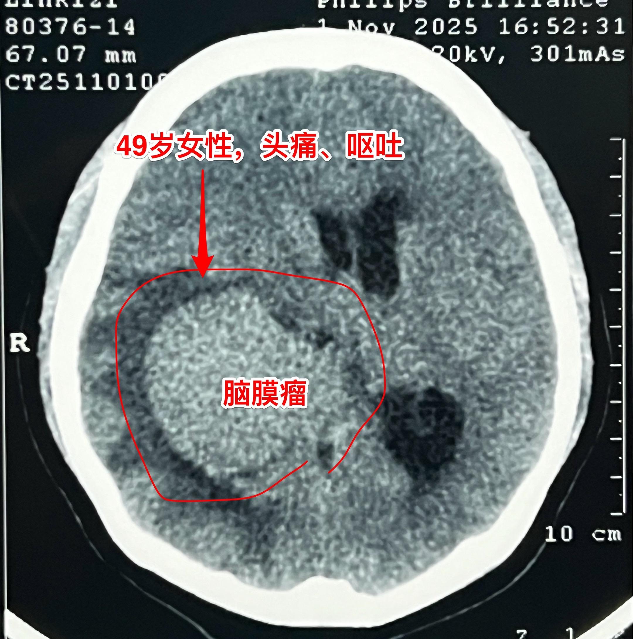 脑室内脑膜瘤也是良性肿瘤。49岁朝鲜族女性，在韩国工作，因头痛、呕吐发...