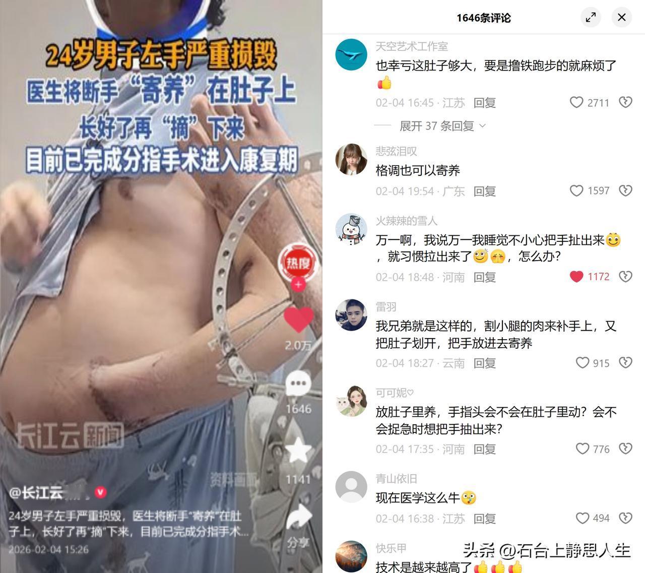 24岁工人把断手种在肚子里

东莞的小王干活时左手被机器碾压，医生没截短残肢