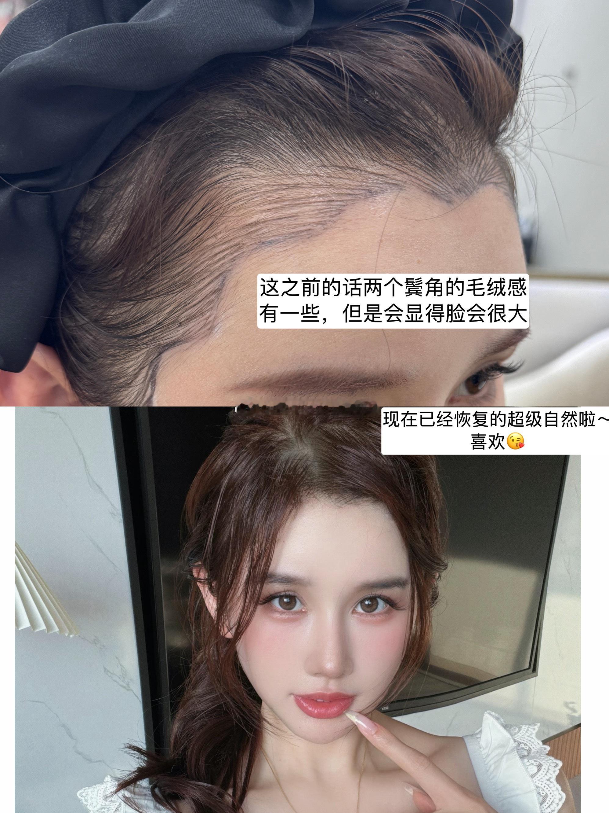 一转眼发际线已经5个多月啦，头发也变回长长的啦～很好看再也不需要发际线粉，变成超