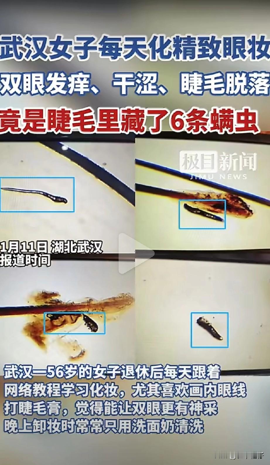 武汉一位56岁女士爱化精致眼妆，每天化内眼线，却因图省事只用洗面奶卸妆，不仔细清