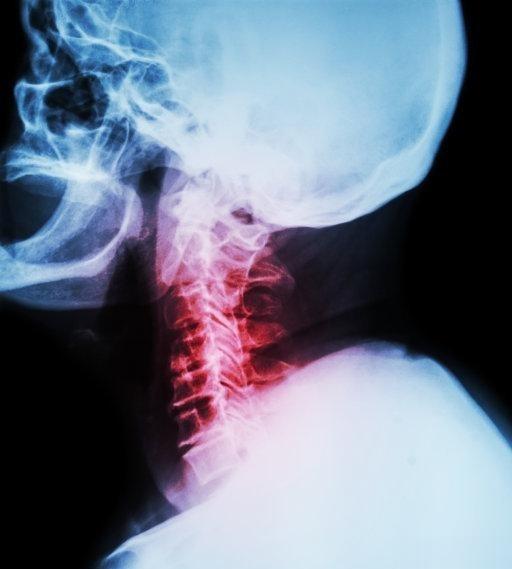 颈椎病是怎么引起的　　1.颈椎的退行性变　　颈椎退行性改变是颈椎病发病的主要原因