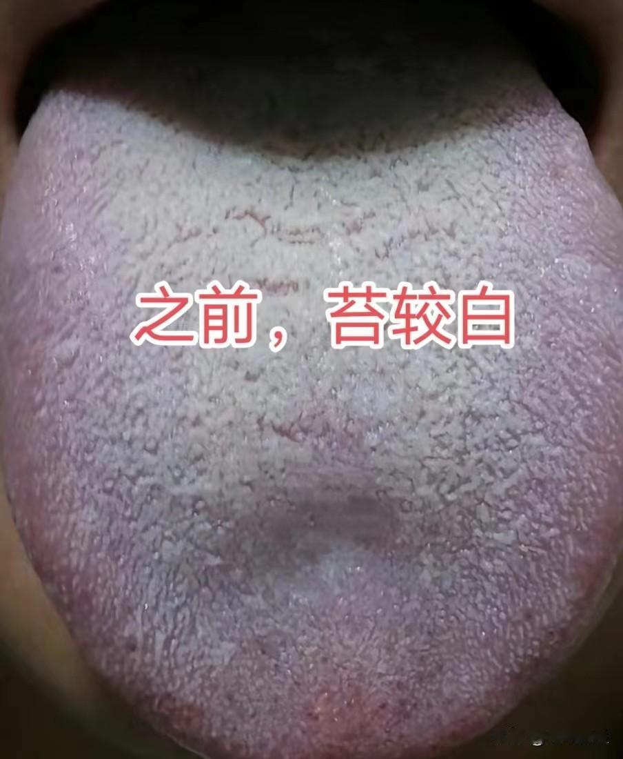 脉有假脉，舌无假舌，舌头有这个特征，说明病症严重了，可不敢再继续拖着了

今天看