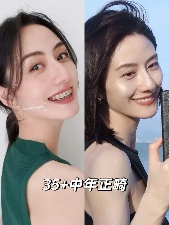 正畸后续😆仅用24元去掉了牙面残留胶！