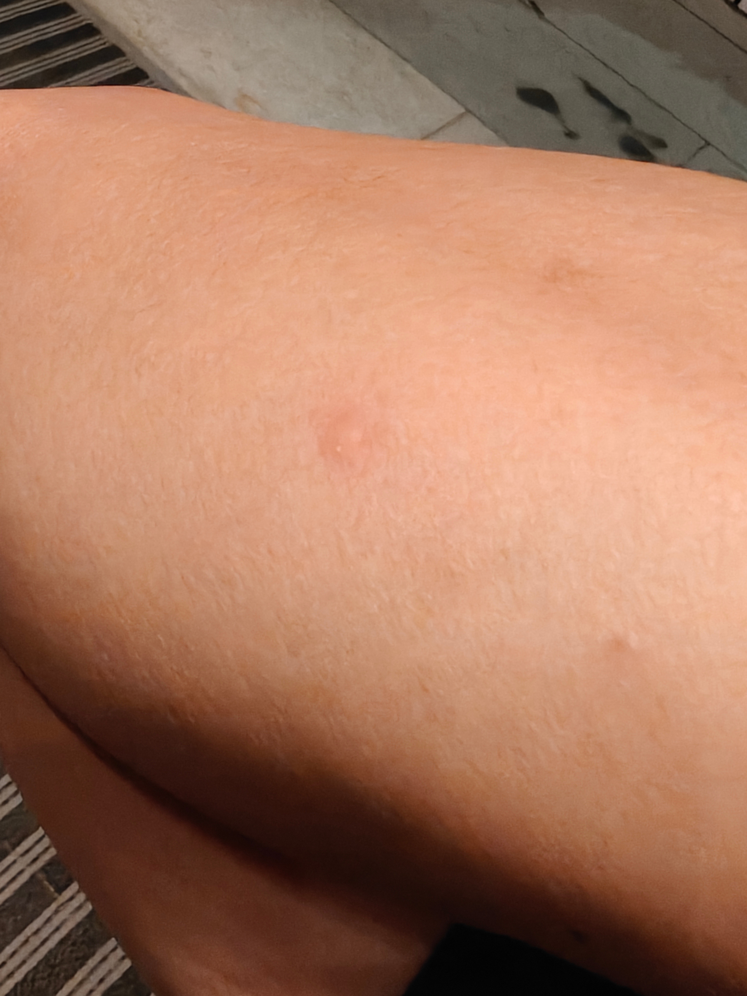 打车打到“蚊子车”，被强制咬了半个小时。我说🦟这生物灭绝了到底有什么坏处