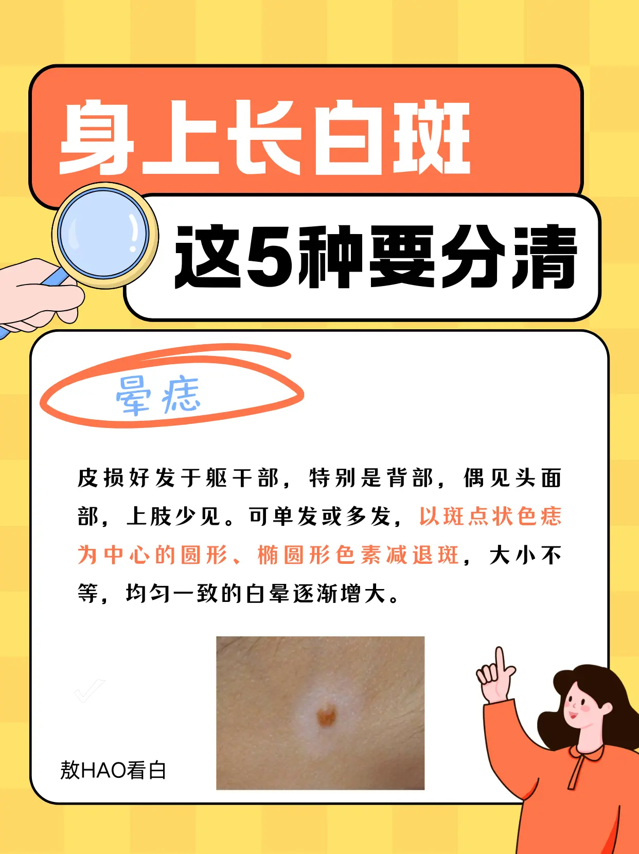白斑不一定是白癜风