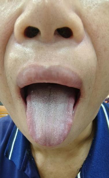 今日舌诊案例分析：

患者：女，56岁

            主诉：入睡难，