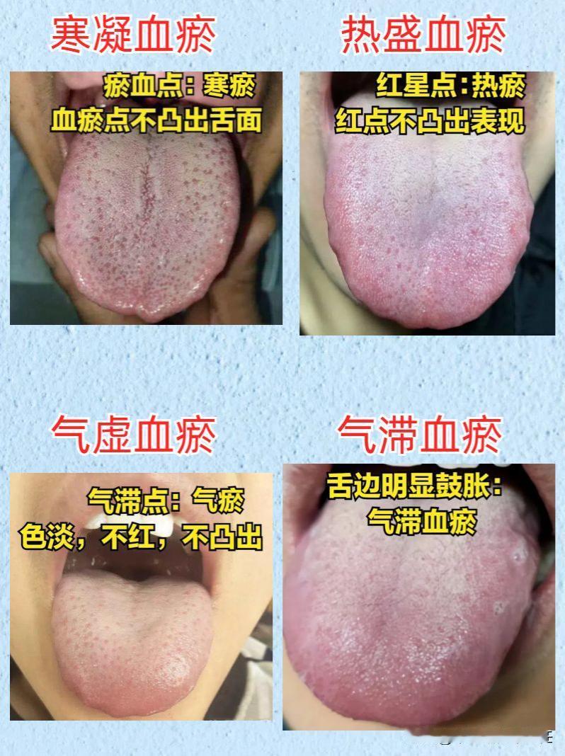 血府逐瘀丸不是万能药，舌象不同，病因也不同，中医教你看舌祛瘀！

『第一种舌象：