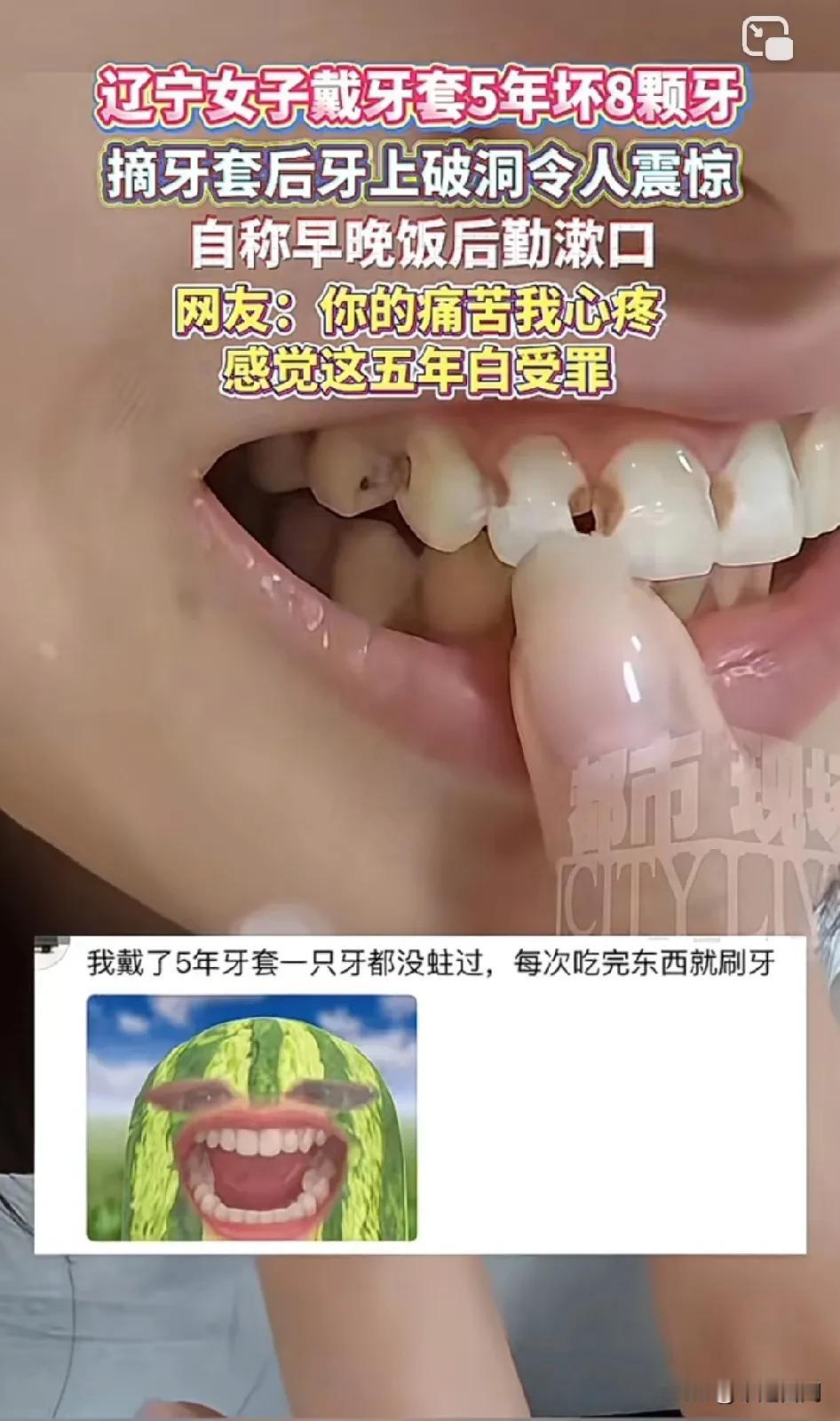 万万没想到，本来为了美观，结果害了自己！
辽宁女子戴牙套5年坏8颗牙，摘牙套后牙