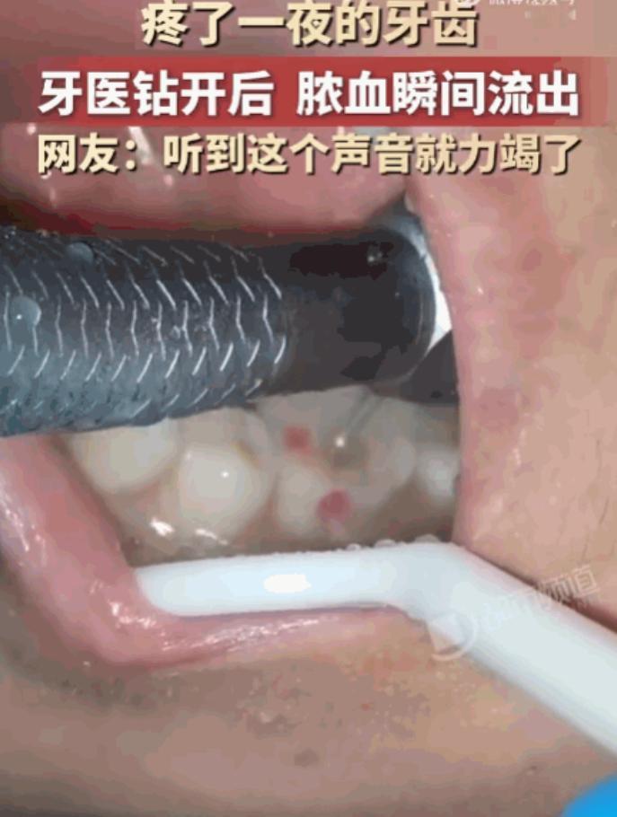 看着都疼！河南，一男子深夜突发剧烈牙痛，整整一夜被折磨得死去活来，崩溃至极。次日