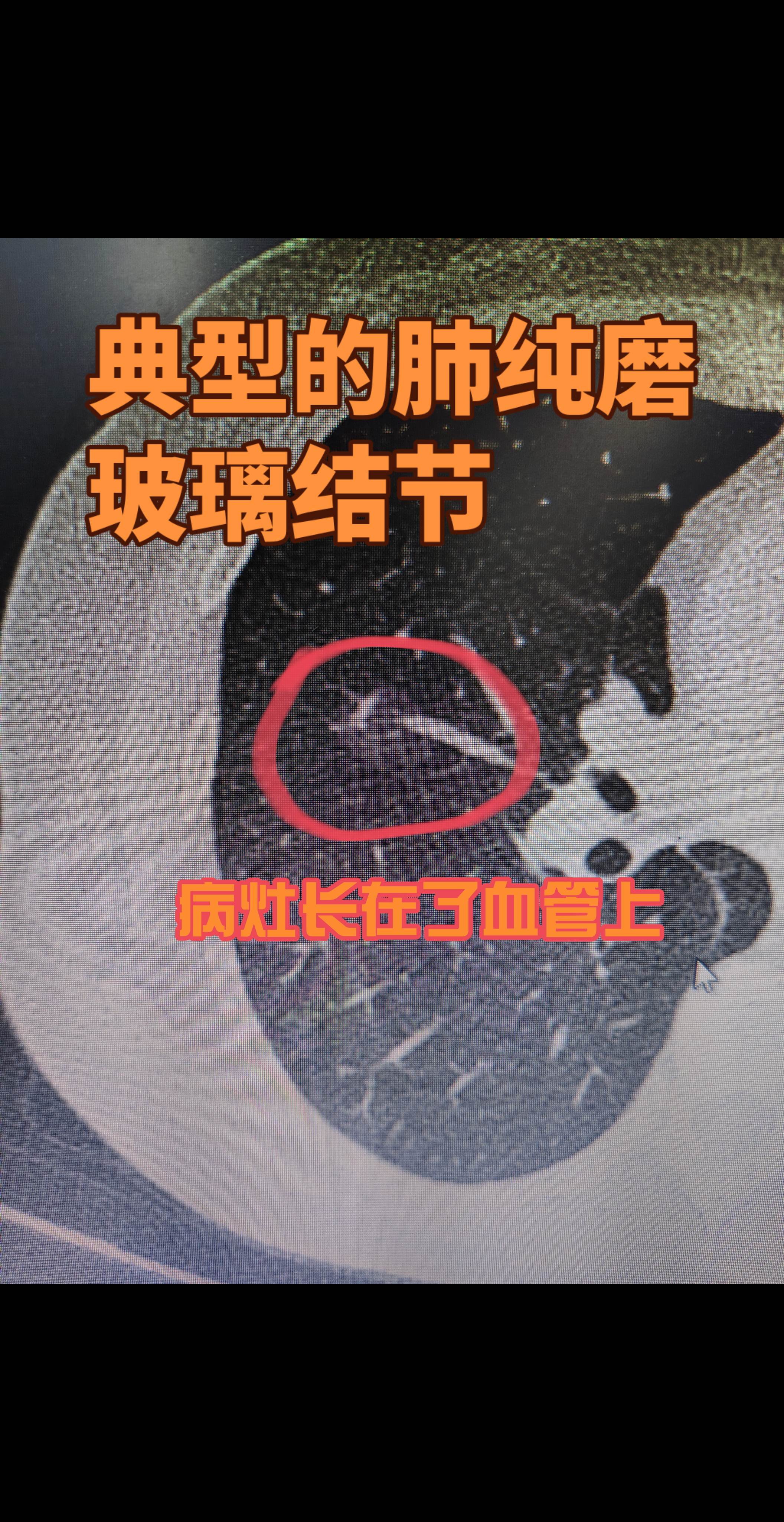 肺纯磨玻璃结节。肺纯磨玻璃结节就像透过一块磨砂玻璃看东西，能隐约看到玻...