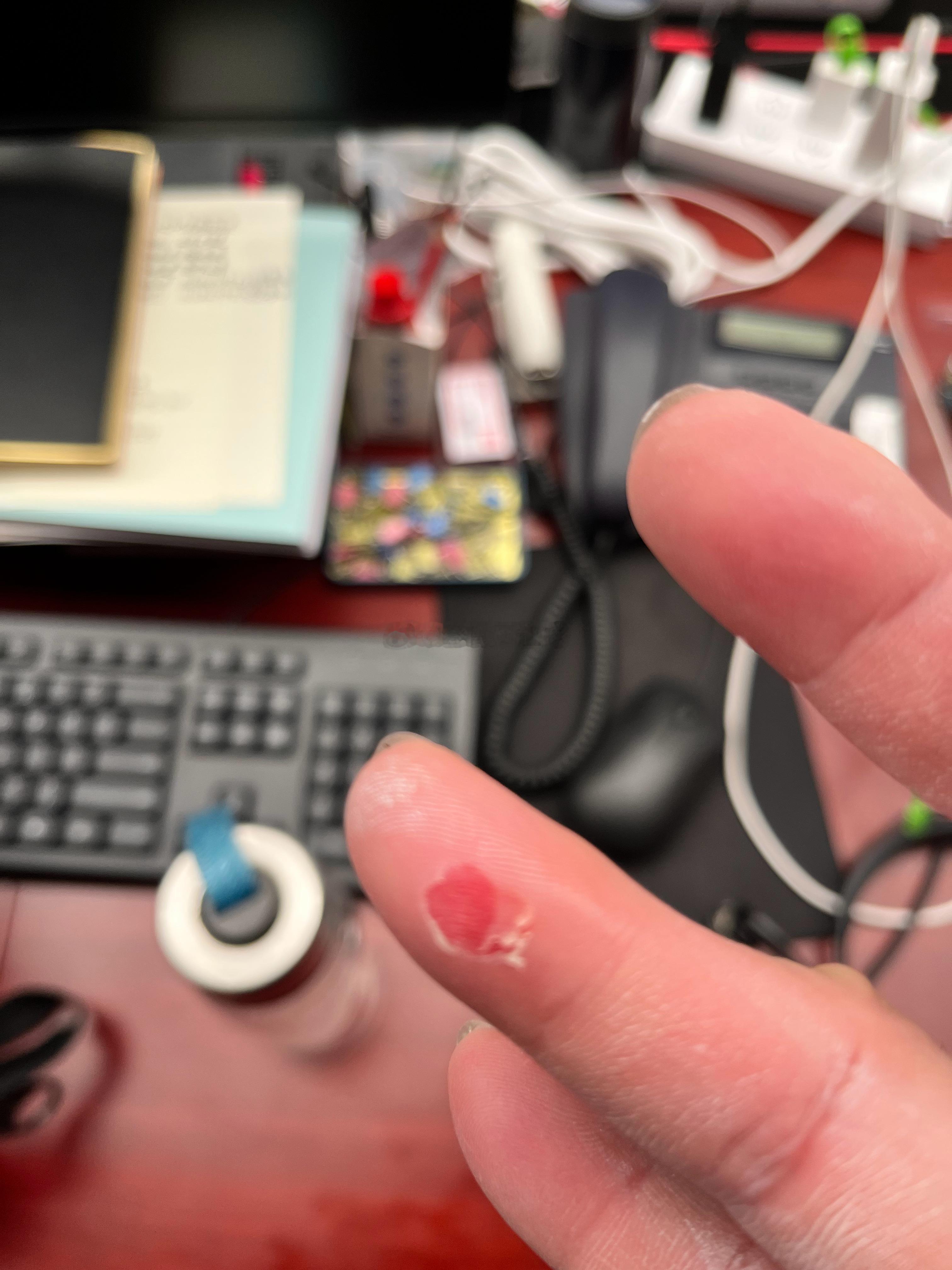 单位拔河比赛，周三拔了两局4场，周五拔了三局7场……最后勇夺亚军……光荣挂彩[笑