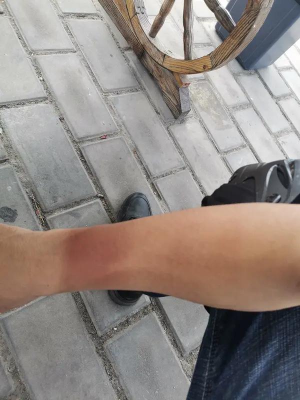 广东一女子参加“躺平大赛”后被确诊日晒疮, 质疑主办方比赛中途改规则:不让打伞、