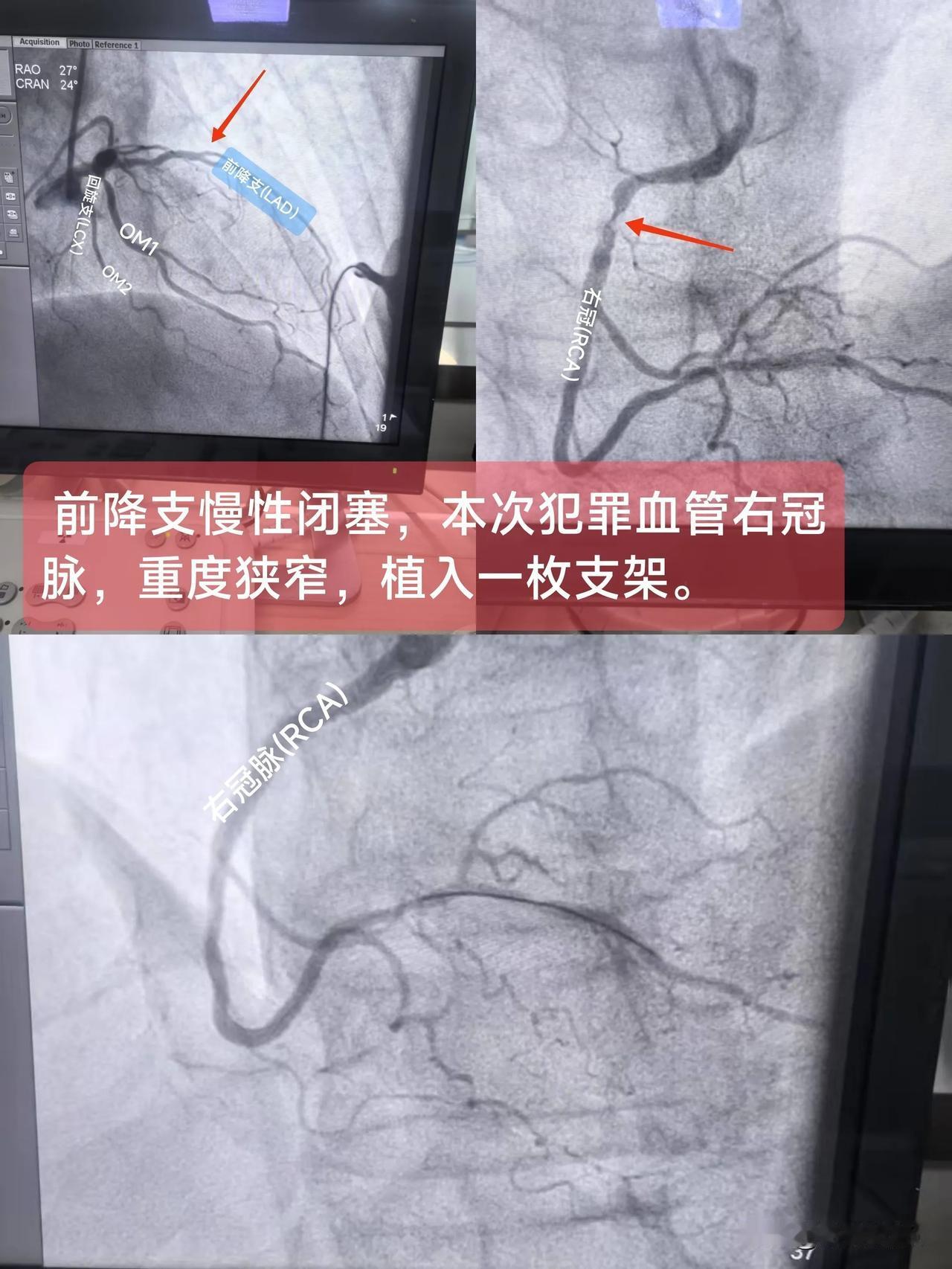 急性ST段抬高型心肌梗死
（前降支慢性闭塞，本次犯罪血管右冠脉重度狭窄）
一、概