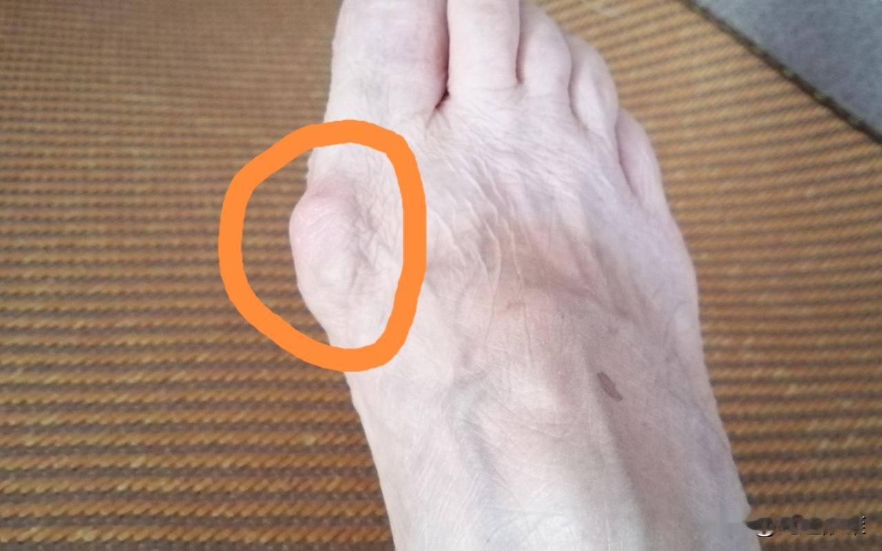 我的脚上有这么个鼓包。
从我记事起，我就发现了它。渐渐地，我发现我妈妈和我妹妹的